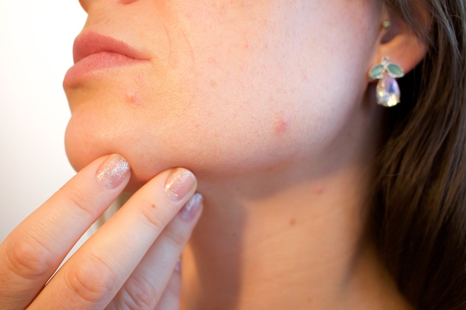 Acne on woman's face